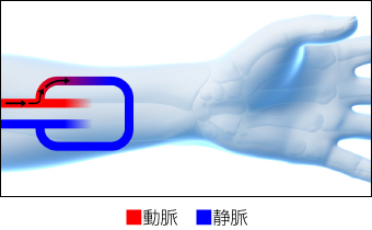 人工血管内シャント